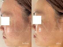 ルアナ(LUANA)/韓国肌管理