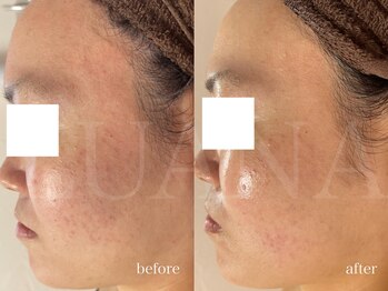 ルアナ(LUANA)/韓国肌管理