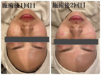 エヌインスキンケアスタジオ 天神店 N-inスキンケアスタジオ/症例【美肌/美白/小顔/毛穴】