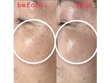 アディ(Adiy)/ビフォーアフター