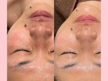 日焼けによる、くすみ、シミ、シワを肌管理。