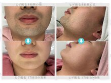 THR方式の光脱毛でごっそり毛が抜けて、毛の悩みからの解放☆