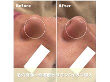 人気の毛穴洗浄◎2回目以降もお得！平日\6,600