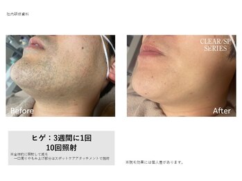 ビュール(VIERU)/メンズ部分脱毛【首・髭】