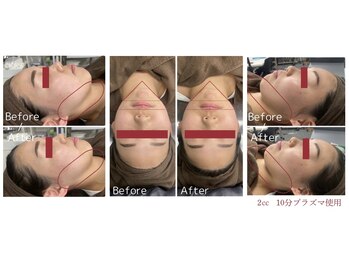 アルビス(ARVISS)の写真/【夏のすっきり小顔】たるみ・二重顎に！NEW★脂肪分解レッドショット＋プラズマ導入+小顔リンパ