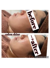 サロンシャイン(Salon Shine)/REVIt陶肌トリートメント１回