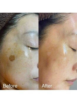 ブランシェ 野々市店 × 椿/シミケア　お客様