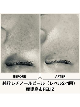 フェリス(FELIZ)/純粋レチノールピール