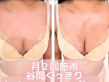 美人バスト 横浜店/バストアップ症例/育乳(6回施術)