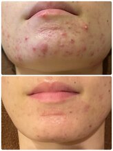 エステサロン 美飾り イオンモール木更津店/before⇒after/ハーブピーリング