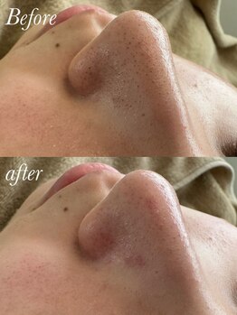 スリビア(SLIVIA)/小鼻洗浄☆ビフォーアフター