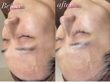 レシェルサロン(Lechelle Salon)/肌改善ハーブピーリング