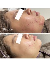 ニキビ研究所 浦和店/思春期ニキビも大人ニキビもケア