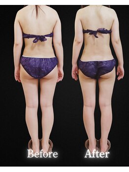 サンティエ(Santie)/計８回施術で大変身