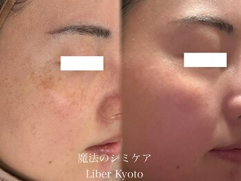 エステティック リベル キョウト 京都駅前店(Esthetic Liber Kyoto)/魔法のシミケア