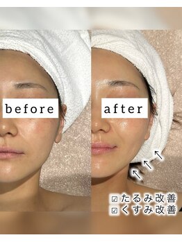 フリーク バイ シュリット 渋谷(fleek! by schritt)/【強炭酸カーボキシーパック】