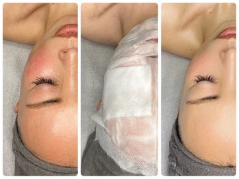 ティアラ(TIARA)の写真/NEW★小顔専門店が構築【上半身まるごと頭蓋骨小顔矯正】×肌質改善【ハイドロ水素パック】