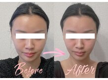 アシュネ(Axiune)/20代★小顔矯正”浮腫み改善”