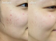 メルシア(merucia)/跡、ニキビケア、赤み改善