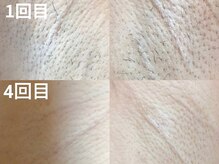 毛質を見極め最短で脱毛☆美白も叶う美容脱毛で黒ずみも綺麗に♪