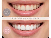 ボニート(Bonito)/ホワイトニング