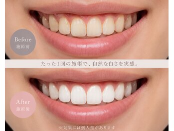 ボニート(Bonito)/ホワイトニング