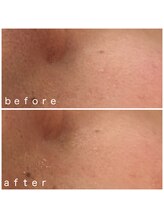 メナードフェイシャルサロン 岐阜茜部/毛穴引き締め&透明感