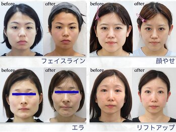 美デザイン 池袋店(美.design)/☆小顔矯正Before-After