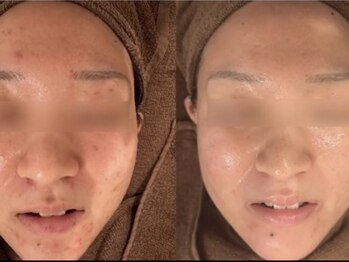 ミベル フェイシャルサロン(MIBELL FACIAL SALON)/お客様症例★リセラ使用