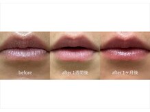"ローマピンク" で唇のくすみを除去して自然なピンク色に。