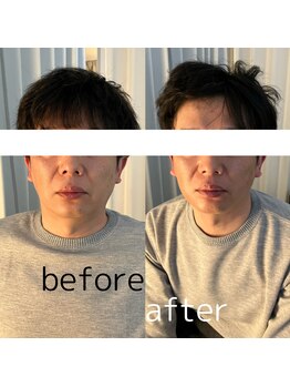 セント 江坂店(SCENT)/美容鍼×頭皮鍼×ヘッドスパ