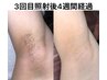 【ワキ脱毛1000円　男性】1回でわかる効果！2回目以降もずっと1100円