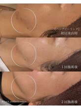 ルカ 北堀江(Luca)/ニキビが気になる方にはこれ☆