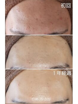 バリーズ(Valley's)の写真/REVI陶肌トリートメントでお肌のハリ・ツヤUP★ターンオーバーを促し、キメを整え透明感のあるお肌へ♪