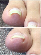 モアクリスタル(More Crystal)/巻き爪補正