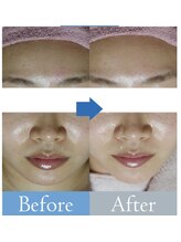 ダイヤモンドビューティー(Diamond Beauty)/ほうれい線たるみケア