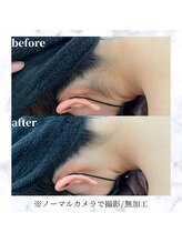 エルアンドエル(L&L)/全身脱毛に含まれるうなじ！