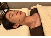 デルタエヌピー63+(δnp63+)/施術[薬院/小顔鍼/フェイシャル]