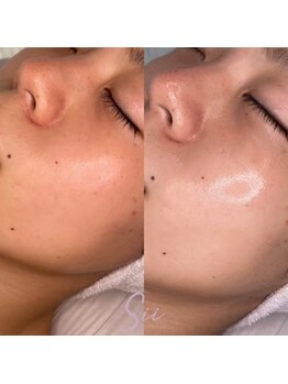 ハーゼ(Hase)/水光生美容液ピーリング◎ツヤ肌