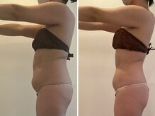 ビューティーマックス(Beauty Max)/痩身　before→after 4ヶ月後