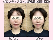 ヴィーネス(VIENESS)/【グロッティプロ＋小顔矯正】