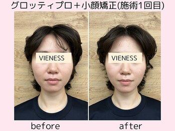 ヴィーネス(VIENESS)/【グロッティプロ＋小顔矯正】