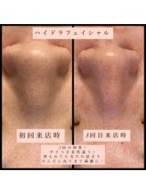 ティアメディカル(Tia Medical)/ハイドラフェイシャル２回の効果