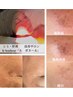 【中澤限定】シミしわ改善＆美白★最新IPL光当て放題×お悩み別美容液導入