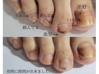 阿良波々岐(アラハバキ)/≪フットケア≫爪の悩みが色々…