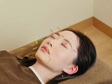 ホープ鍼灸整骨院/美容鍼の施術風景