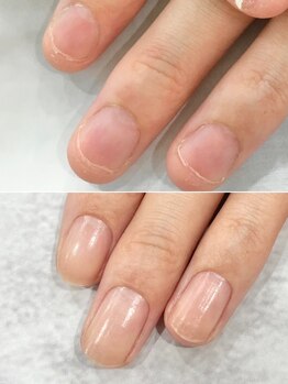 リファーレ(RIFARE)/【深爪矯正】締まった縦長爪に!