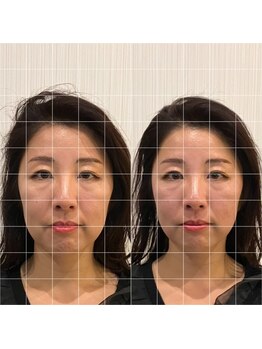 ナギ鍼灸院(nagi鍼灸院)/美容鍼 1回　ビフォーアフター