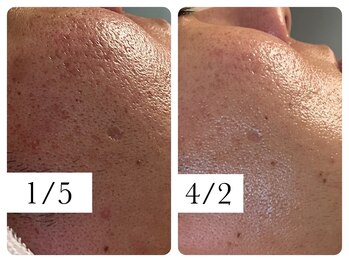 サロン ド エメ(salon de aimer)/赤み、凹凸毛穴、開き毛穴変化