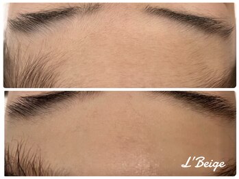 レ ベージュ(L’Beige)/3才からのキッズ脱毛